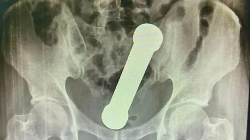 دخول دمبل في جسم مسن وإنقاذه بصعوبة