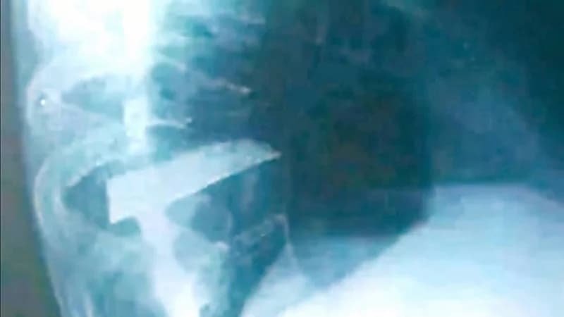 أطباء يخرجون خنجر من ظهر جزائري لازمه 25 عاماً