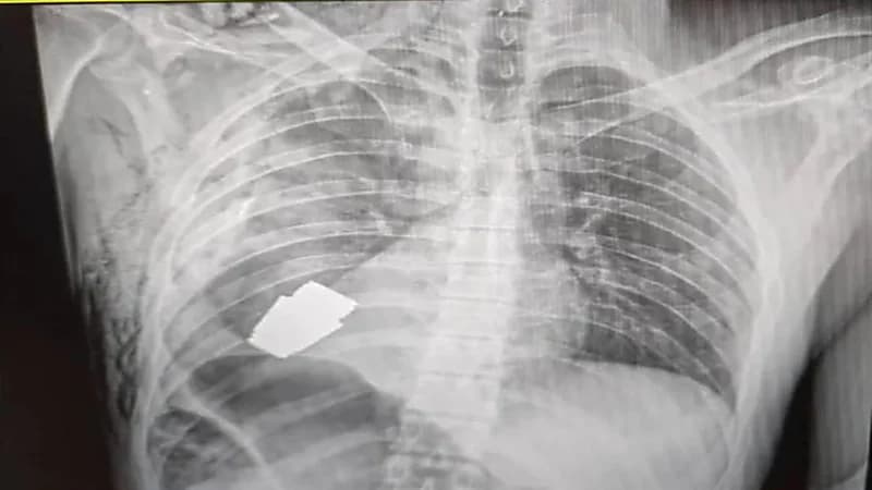 استخراج قنبلة حية من جسد جندي أوكراني