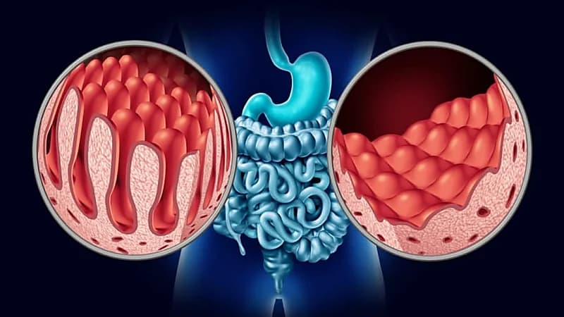 أبرز أعراض مرض "السيلياك" المناعي