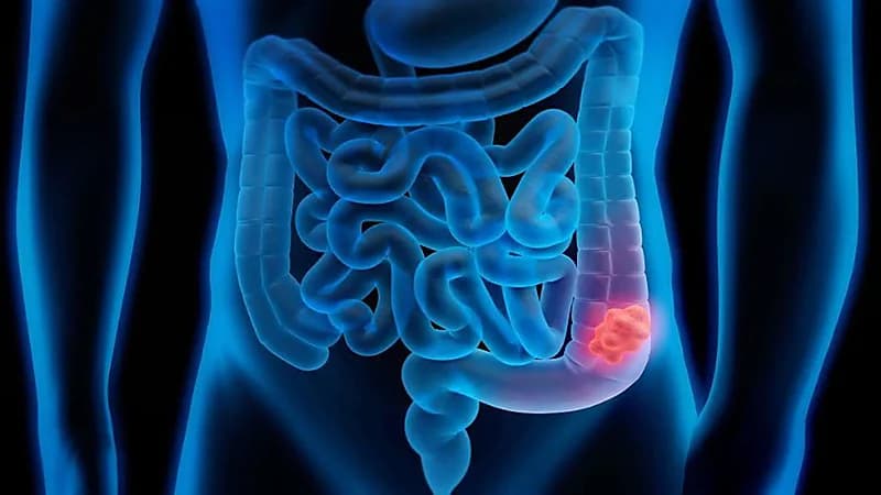 طرق الوقاية من الإصابة بسرطان القولون