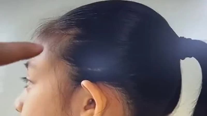 بالفيديو.. طبيب جلدية يحذر من تسريحة منتشرة بين البنات