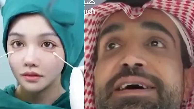 استشاري يحذر من حقن الفيلر في الجفن السفلي للعين: يشوّه الملامح.. فيديو