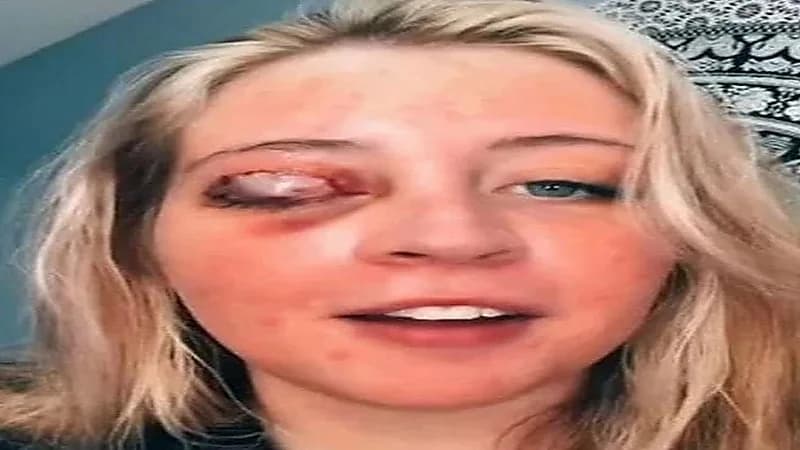 كلب يفقأ عين فتاة بسبب رموش اصطناعية