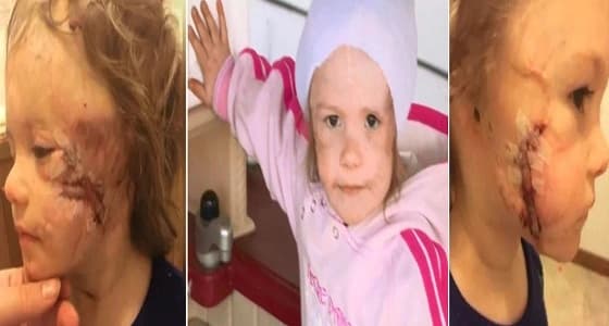 طفلة تفقد أذنها في هجوم وحشي لكلب مفترس