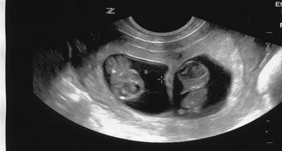 4 علامات تظهر على الحامل بتوأمين