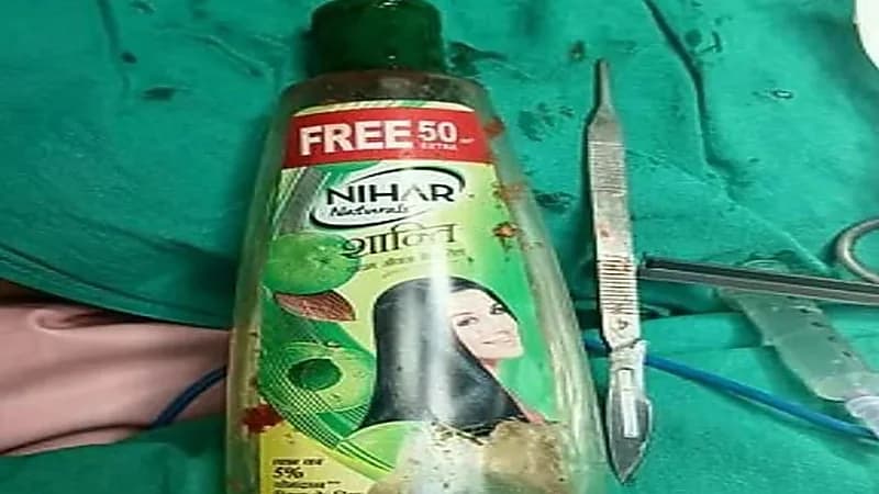 استخراج زجاجة من معدة رجل هندي