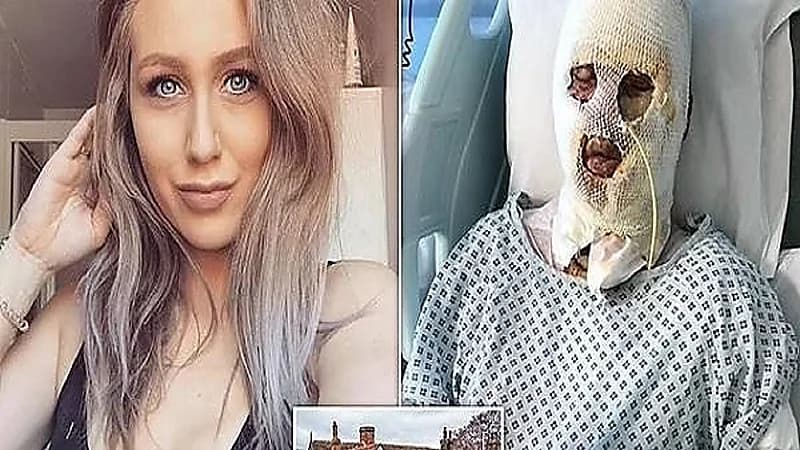 مزحة تتسبب في تشويه وجه فتاة حسناء