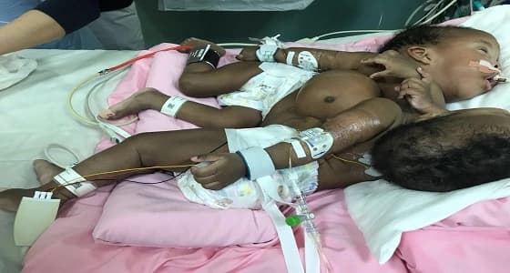 فصل التوأم السوداني " جود وجنا " بمستشفى الملك عبدالله في الرياض الأحد القادم
