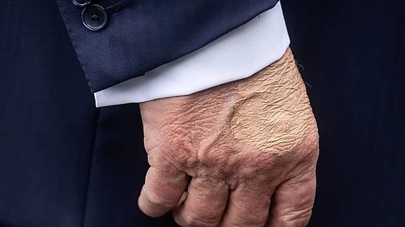 كدمة غامضة على يد ترامب تثير التساؤلات والبيت الأبيض يوضح الأسباب .. فيديو وصور