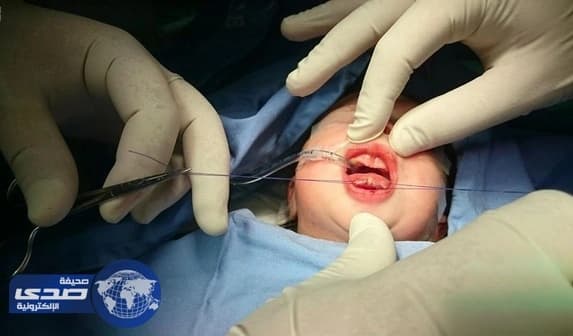 بالصور.. إنهاء معاناة رضيعة من تشوه خلقي نادر بمستشفى الولادة بنجران