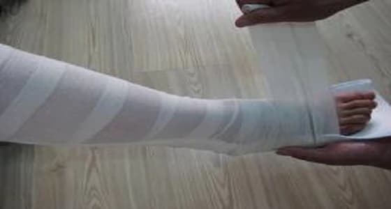 التحقيق في واقعة وضع جبيرة بشكل خاطئ كادت تبتر قدم مريض