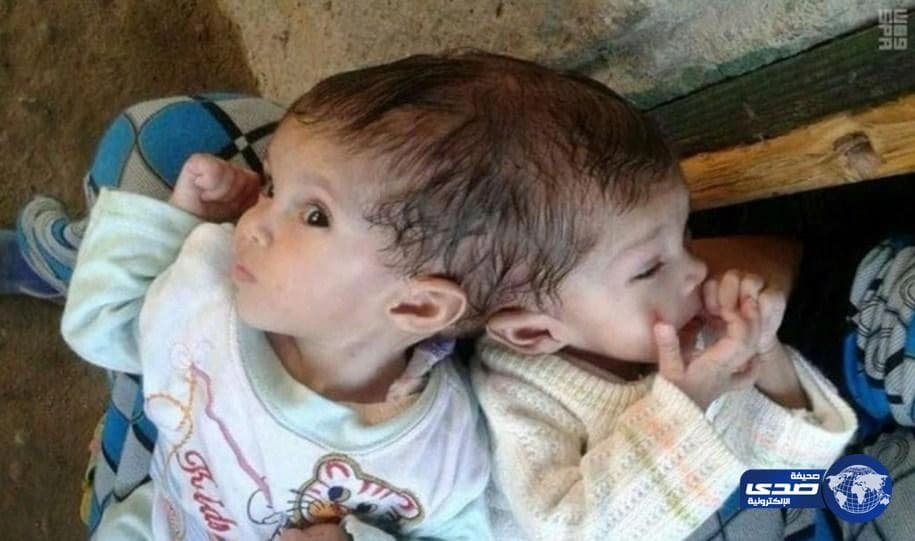 خادم الحرمين يأمر بعلاج التوأم المصري الملتصق «منة ومي»