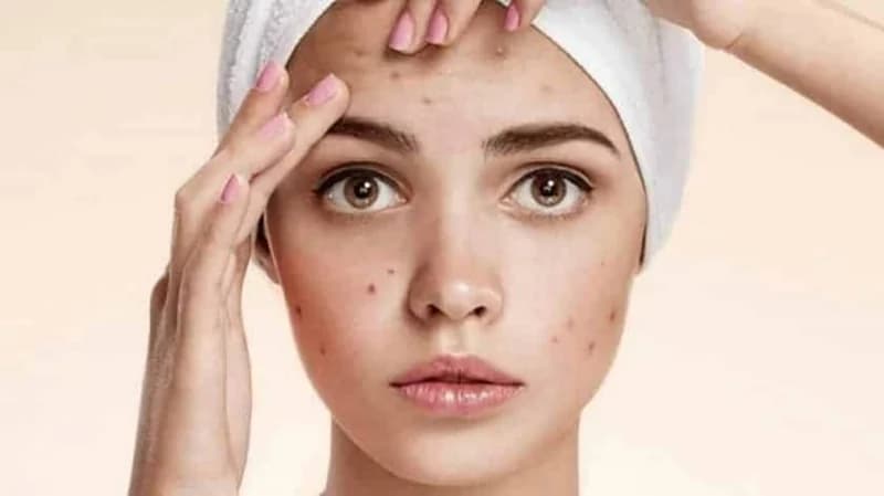 روتين البشرة الدهنية خلال فصل الصيف