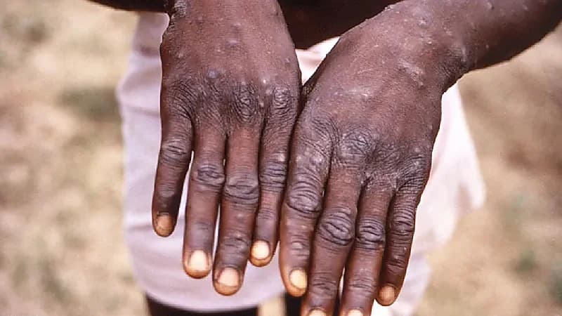 بالفيديو.. استشاري: من فوق 47 عاما قد يحتاجون لجرعات تنشيطة ضد جدري القردة