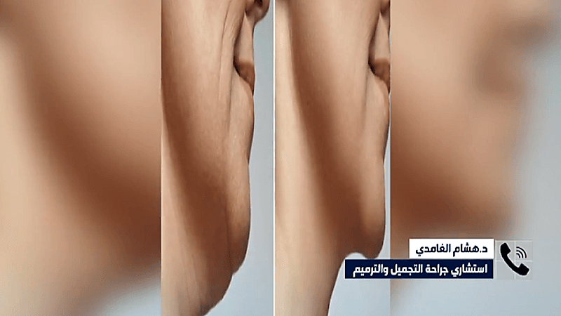 استشاري:لم يثبت علميا إسهام الهواتف والأجهزة الذكية في تكوين "الذقن المزدوج"
