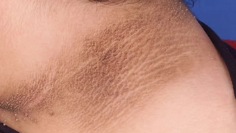 أسباب مشكلة اسمرار الرقبة وطرق علاجها