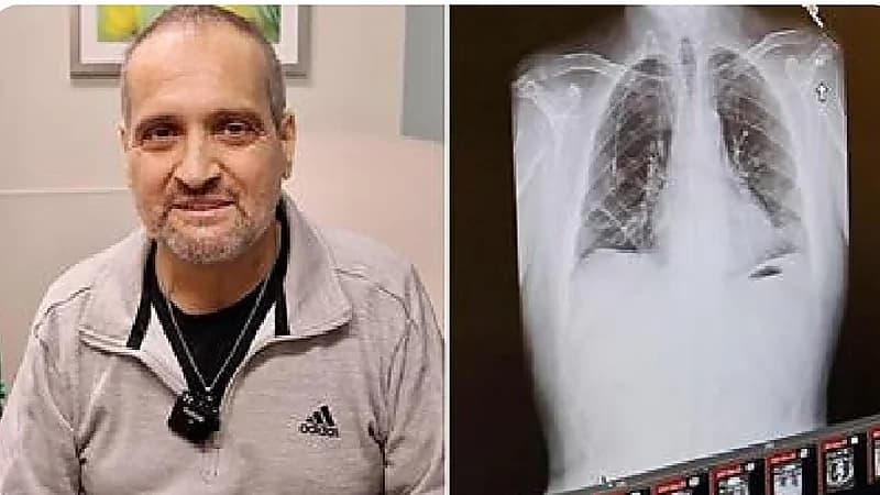 نجاح عملية زراعة "رئة" لشخص مصاب بالسرطان