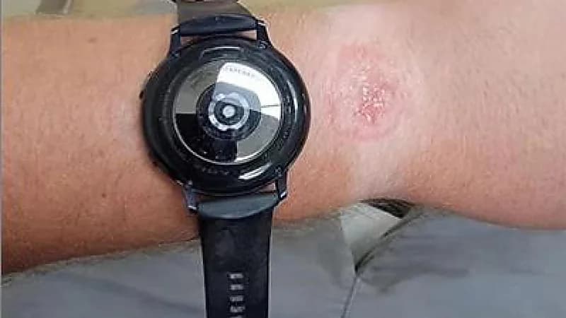 ساعة ذكية تتسبب في حرق يد مستخدم أثناء النوم