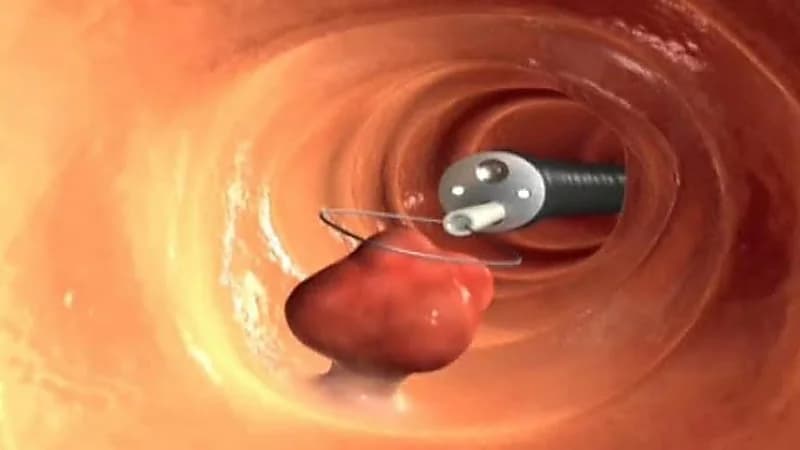 استشاري يكشف عن أبرز أعراض سرطان القولون