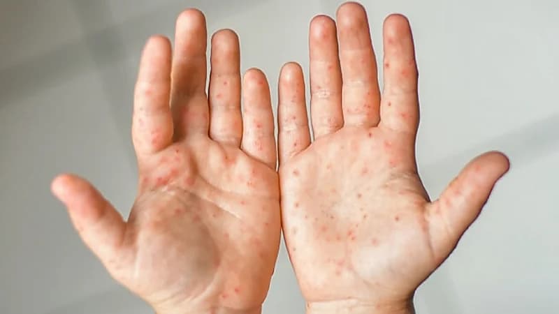 استشارية توضح أعراض عدوى فيروسية تشيع بين الأطفال .. فيديو