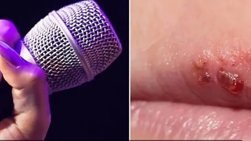 فتاة تعاني من فيروس الهربس منذ 8 سنوات بسبب ميكروفون