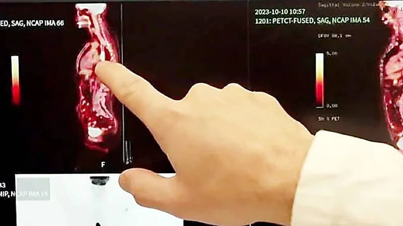 علاج ثوري للسرطان: تقنية نانوية تستهدف الخلايا بدقة دون جراحة