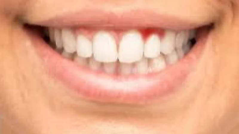 طبيب: اهمال نظافة الفم تزيد من مخاطر حدوث النوبات القلبية