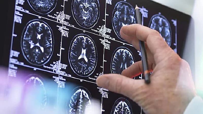 أخصائية أورام: الروائح الكريهة قد تشير لوجود ورم في الدماغ