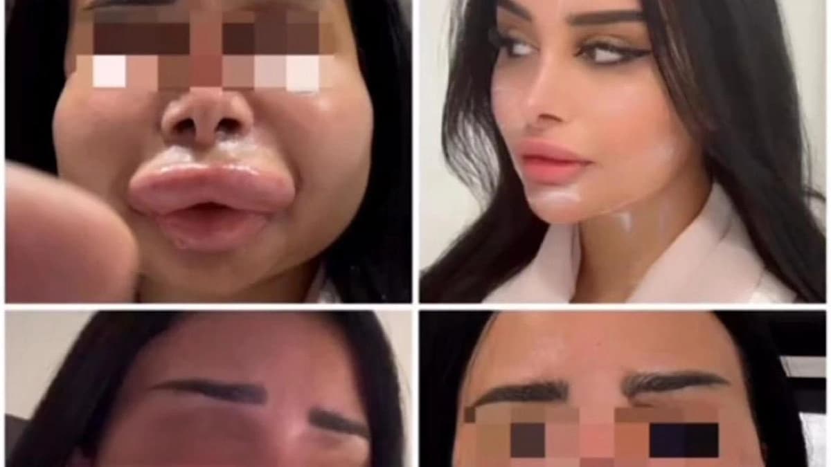 تشوه وجه دانة الشهري نتيجة عملية تجميل فاشلة غيّرت ملامحها بالكامل