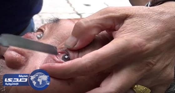 ⁠⁠⁠⁠⁠بالفيديو.. حلاق ينظف عيون الزبائن بـ " السكين "