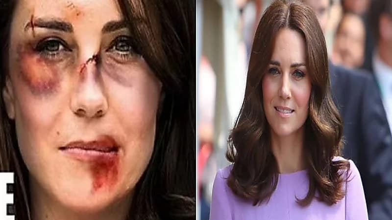 صور صادمة تظهر تعرض كيت ميدلتون للتعنيف