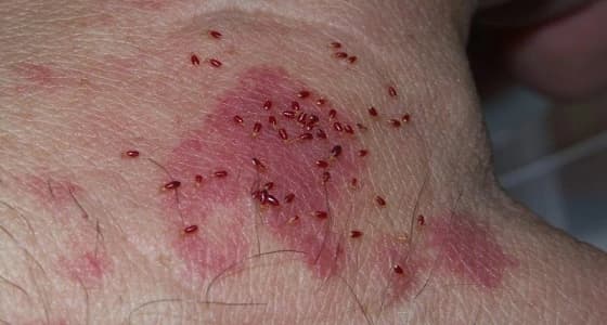 للمرة الثانية .. شكوى ضد " بريتيش أيرويز " بشأن بق الفراش