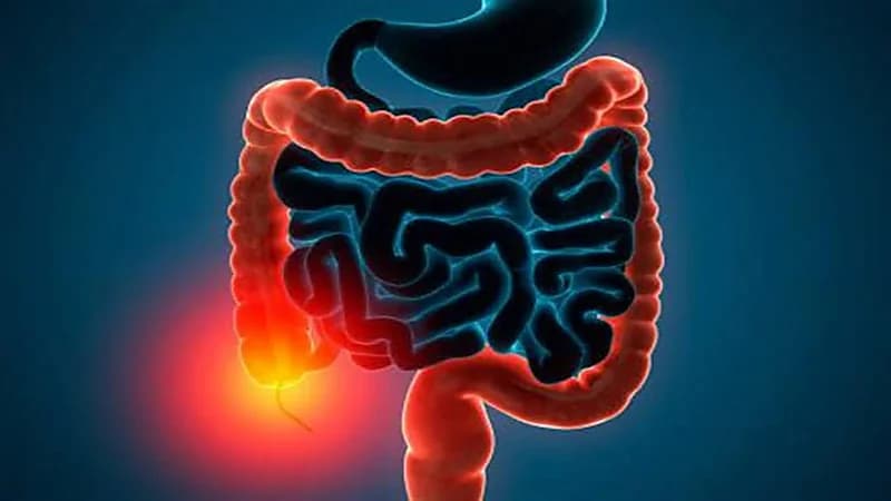 أعراض تشير إلى الإصابة بمتلازمة القولون