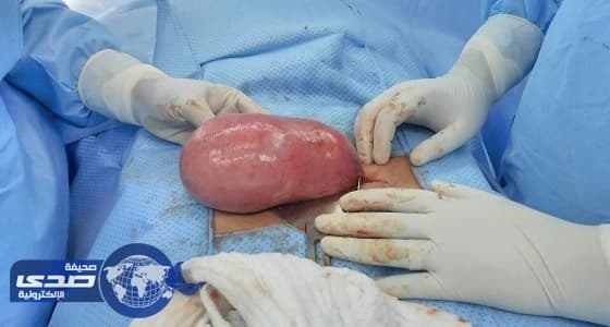استئصال ورم يزن أكثر من كيلوا جرام من رحم سيدة اربعينية بمستشفى باللحمر