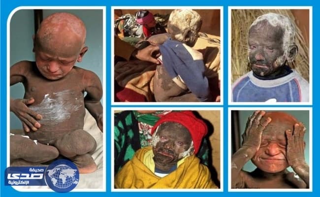 بالفيديو والصور.. مرض جلدي نادر يحول طفل هندي لصخره ويحرمه من طفولته