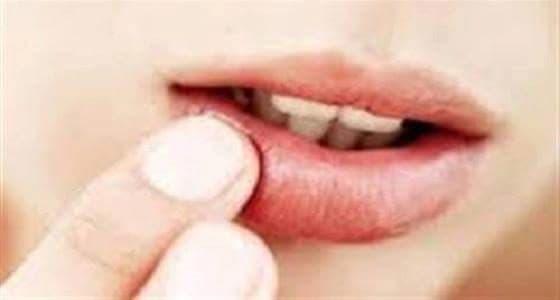 وصفة طبيعية للتخلص من تشققات الشفتين خلال الشتاء