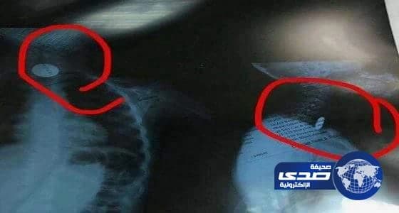 بالصور ..فريق طبي ينقذ حياة طفلة ابتلعت قطعة معدنية بحفر الباطن