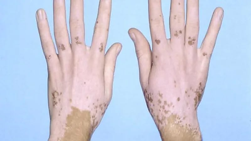 بالفيديو.. استشاري يكشف عن آخر الأساليب الطبية لعلاج "البرص والبهاق"