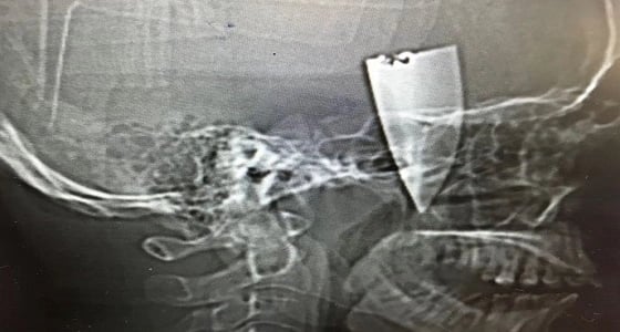 جراحة ناجحة لشاب مصاب في وجهه بمجمع الملك فيصل بالطائف