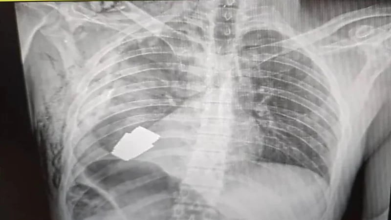 استخراج قنبلة حية من جسد جندي أوكراني