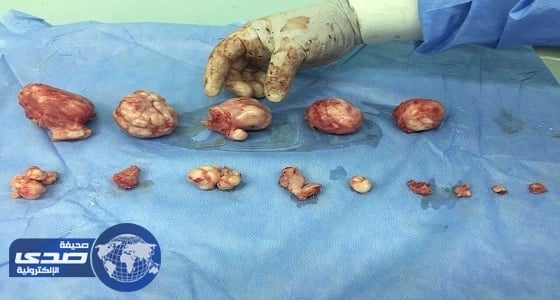 استئصال 10 كتل أورام ليفية من رحم مريضة بمستشفى بيشة