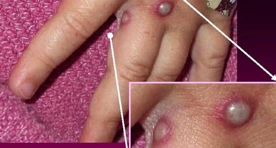 إحذر.. فيروس غامض يمكنه قتل 10 % من سكان العالم