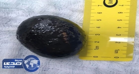 فريق طبي بمستشفى الخميس العام يستخرج حصوة بطول 6 سم من مثانة مريض