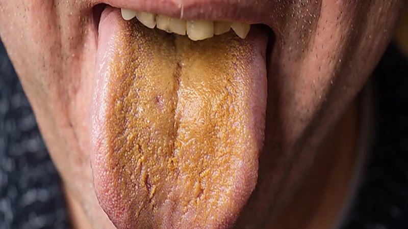 بالفيديو.. الأسباب الرئيسية لتغير لون اللسان