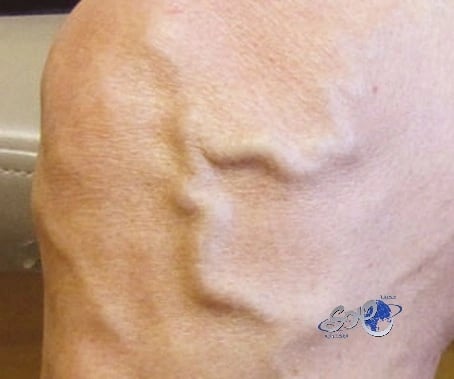 دوالي الساقين