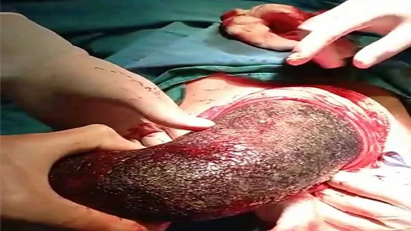 أطباء يسحبون كتلة شعر ضخمة من معدة فتاة