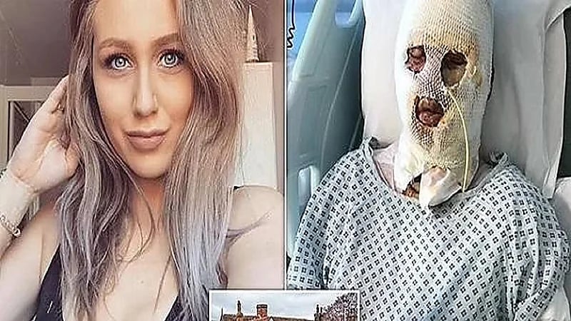 مزحة تتسبب في تشويه وجه فتاة حسناء