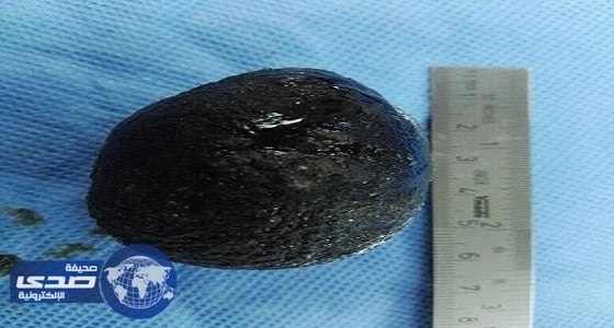 استئصال مرارة لمريضة تحتوي على حصوة «6سم» بحفر الباطن