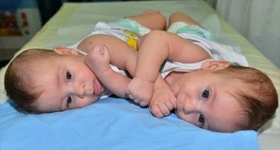 إجراء 44 عملية لفصل توائم سيامية من 20 دولة في المملكة